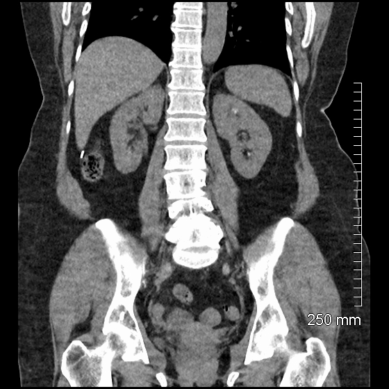 Displaced cholecystectomy clips | Radiology Case | Radiopaedia.org