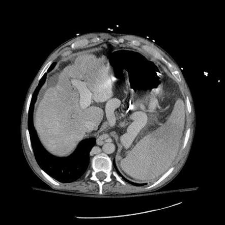 Cystic fibrosis (abdominal manifestations) | Radiology Reference ...