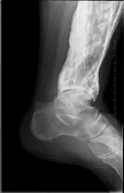 Paget Disease Bone Radiology Reference Article Radiopaedia Org