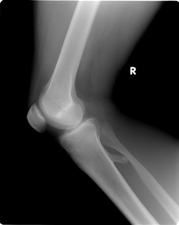 Osteochondroma | Radiology Case | Radiopaedia.org