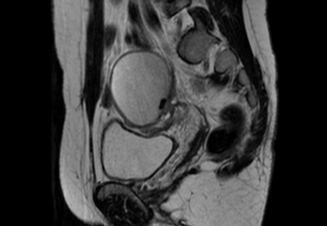 Endometrioma - T2 Dark Spot Sign | Image | Radiopaedia.org