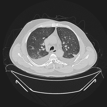 Poland syndrome | Image | Radiopaedia.org