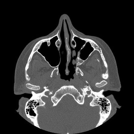 Bilateral ectopic infraorbital nerves | Image | Radiopaedia.org