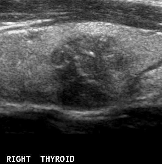 Microcalcifications in a thyroid nodule | Image | Radiopaedia.org