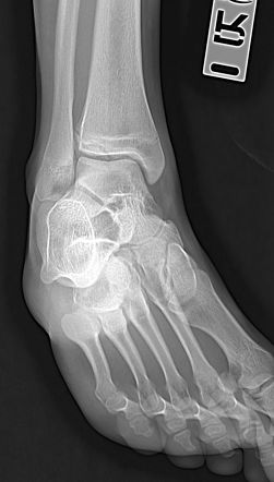 Tillaux fracture | Radiology Case | Radiopaedia.org