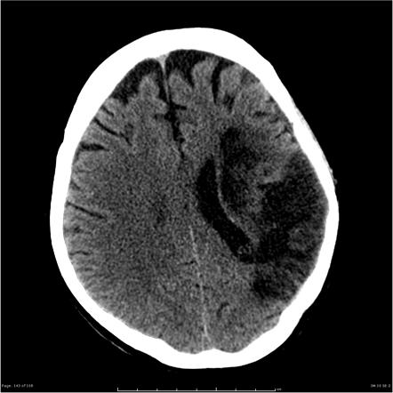 Stroke (summary) | Radiology Reference Article | Radiopaedia.org