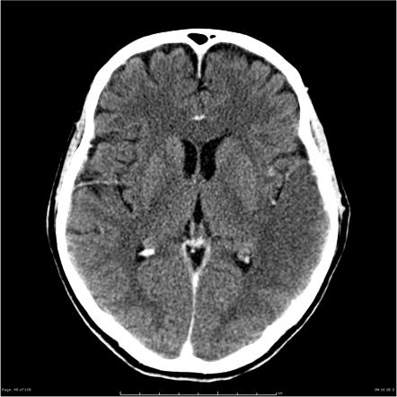 Cerebral edema (summary) | Radiology Reference Article | Radiopaedia.org