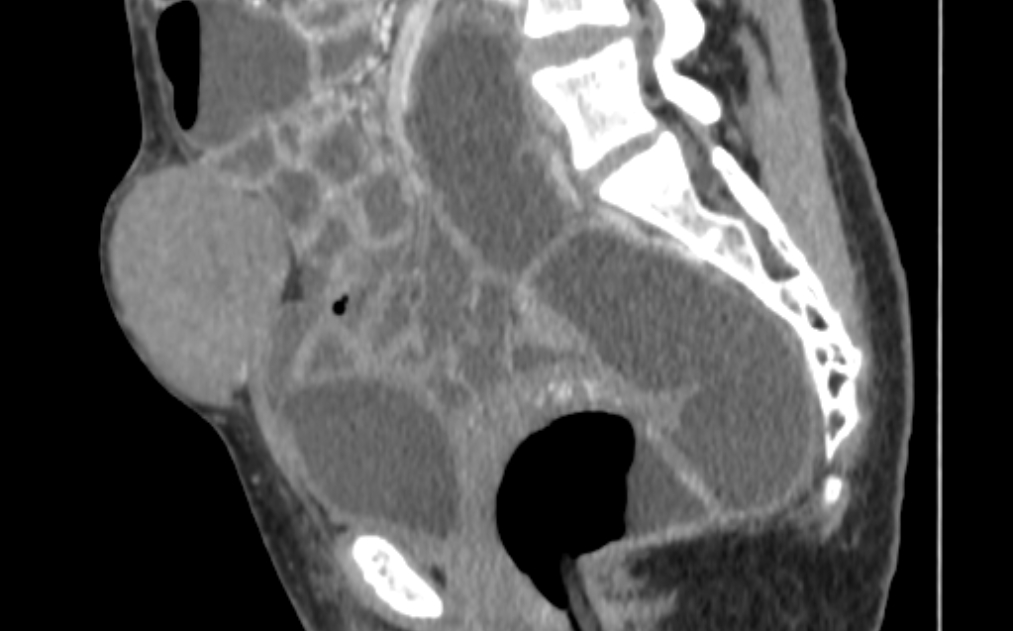 Desmoid tumor of rectus abdominis | Image | Radiopaedia.org