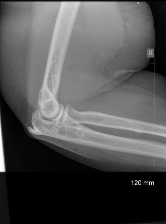 Enthesophyte | Radiology Reference Article | Radiopaedia.org