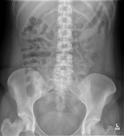 Ulcerative colitis - thumbprinting and lead pipe signs | Radiology Case