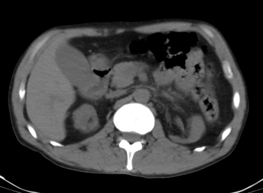 Uremic Encephalopathy | Image | Radiopaedia.org