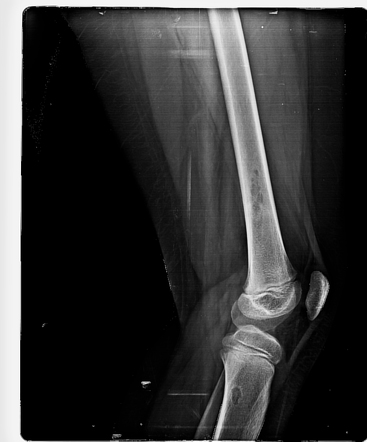 Stress fracture of distal femur | Image | Radiopaedia.org