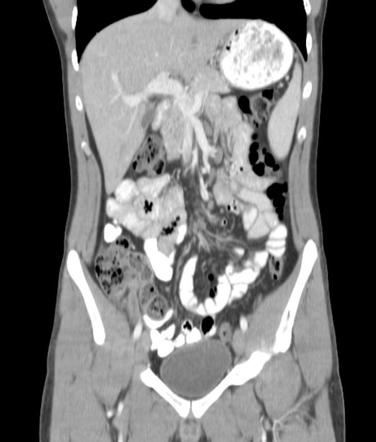 Indirect Amyand hernia with gangrenous appendicitis | Radiology Case ...