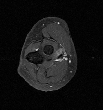 Tenosynovial giant cell tumor - biceps brachii | Image | Radiopaedia.org