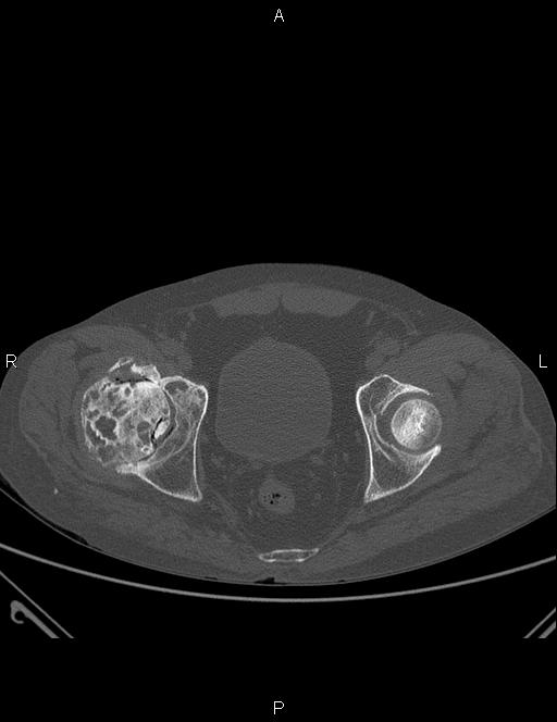 Avascular necrosis: femoral head | Image | Radiopaedia.org