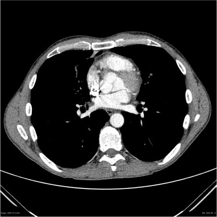 Allergic bronchopulmonary aspergillosis (ABPA) | Image | Radiopaedia.org