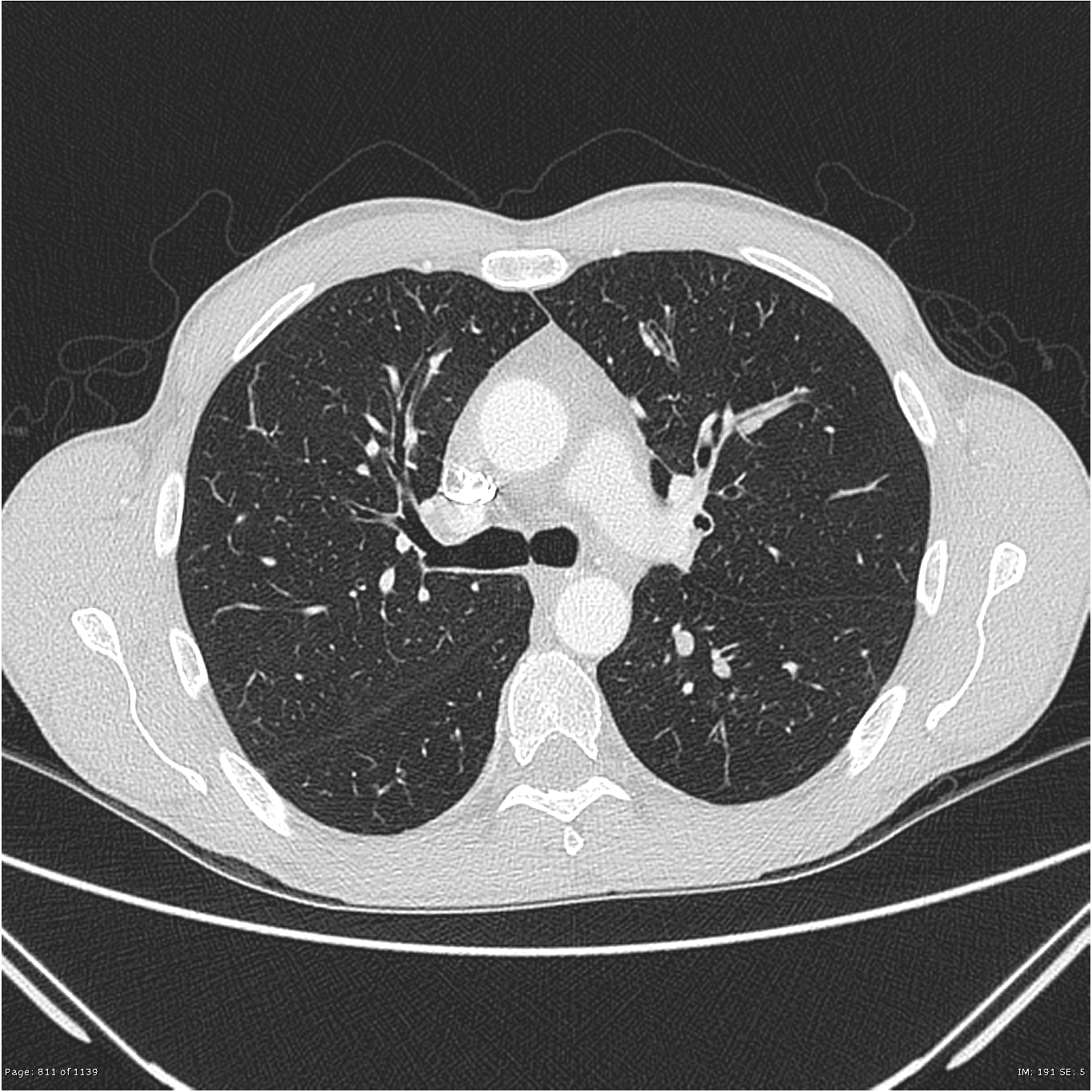 Allergic bronchopulmonary aspergillosis (ABPA) | Image | Radiopaedia.org