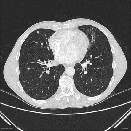 Central bronchiectasis | Radiology Reference Article | Radiopaedia.org