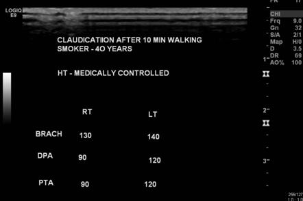 ankle brachial index ultrasound radiology