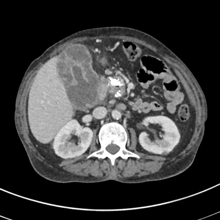 Xanthogranulomatous Cholecystitis | Radiology Case | Radiopaedia.org