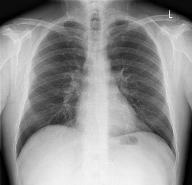 Pleural lipoma | Radiology Reference Article | Radiopaedia.org