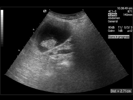 Gallbladder polyp | Radiology Reference Article | Radiopaedia.org