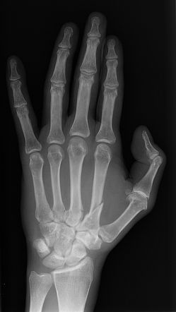 Metacarpal fractures | Radiology Case | Radiopaedia.org