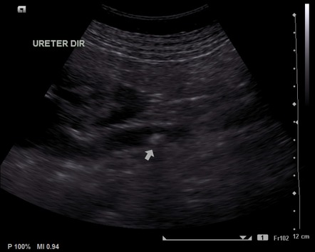 Anatomy Of Urolithiasis