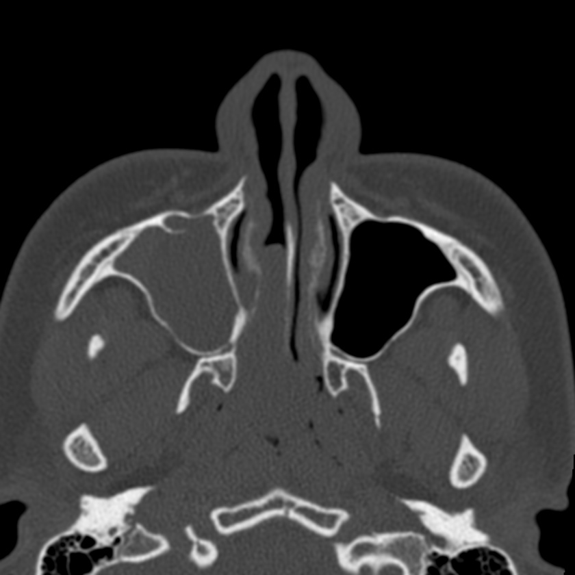 Antrochoanal Polyp Image