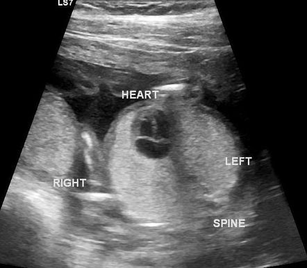 Congenital high airways obstruction syndrome | Image | Radiopaedia.org