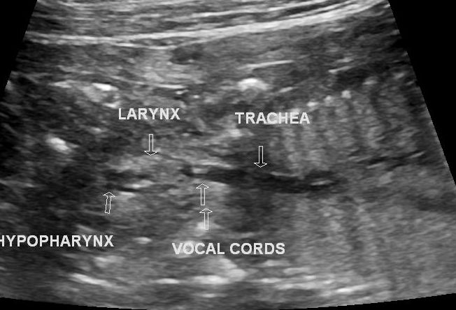 Congenital High Airways Obstruction Syndrome Image