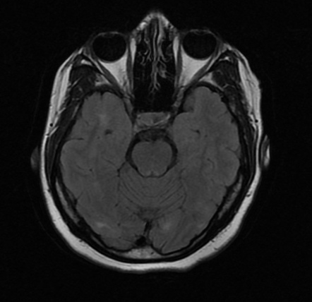 Posterior reversible encephalopathy syndrome | Radiology Case ...