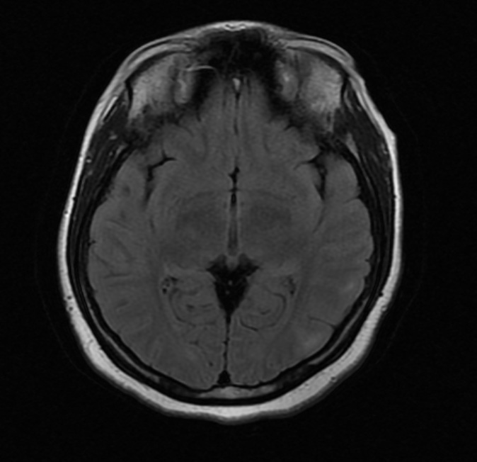 Posterior reversible encephalopathy syndrome | Image | Radiopaedia.org