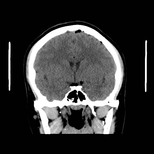 File:Traumatic pneumocranium, cribriform plate fracture and ...