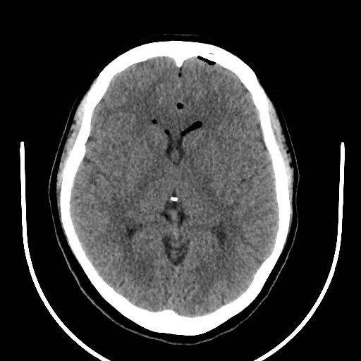 File:Traumatic pneumocranium, cribriform plate fracture and ...