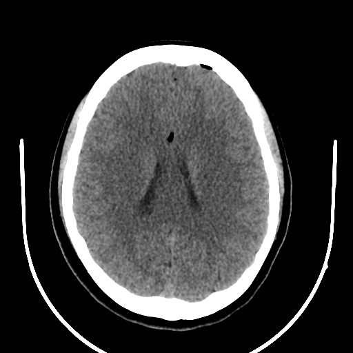 File:Traumatic pneumocranium, cribriform plate fracture and ...