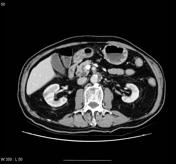 Intraductal papillary mucinous neoplasm | Radiology Reference