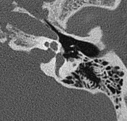 Otosclerosis Radiopaedia