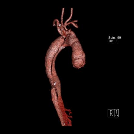 Aortic Dissection - De Bakey Type III / Stanford B | Radiology Case ...