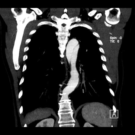 Aortic Dissection - DeBakey Type III / Stanford B | Image | Radiopaedia.org