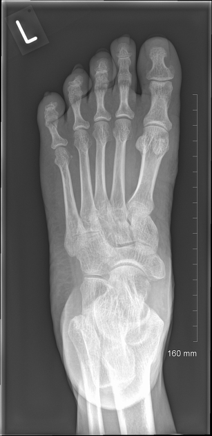 Types Of Fifth Metatarsal Fracture, 50% OFF