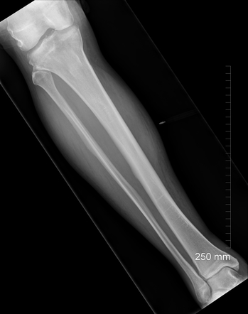 Growth arrest lines in adult | Radiology Case | Radiopaedia.org