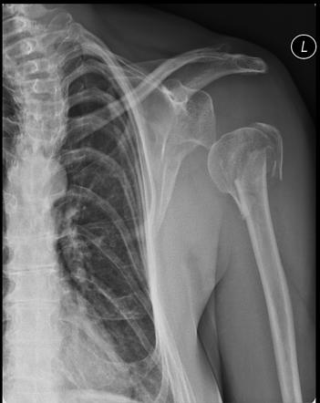 Humeral fracture with shoulder dislocation | Radiology Case ...