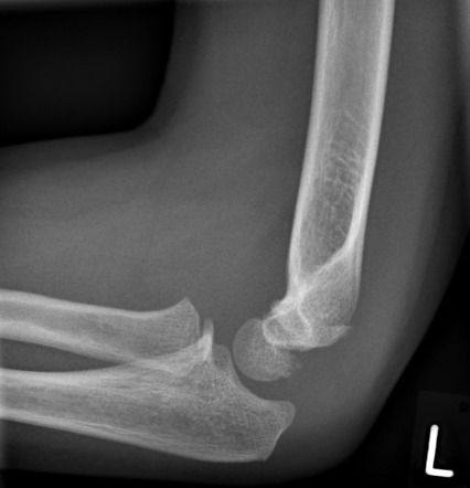 Lateral humeral condyle fracture | Image | Radiopaedia.org