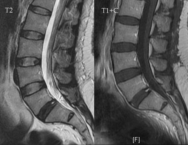 Annular Fissure L5 S1 Radiology Case Radiopaedia Org