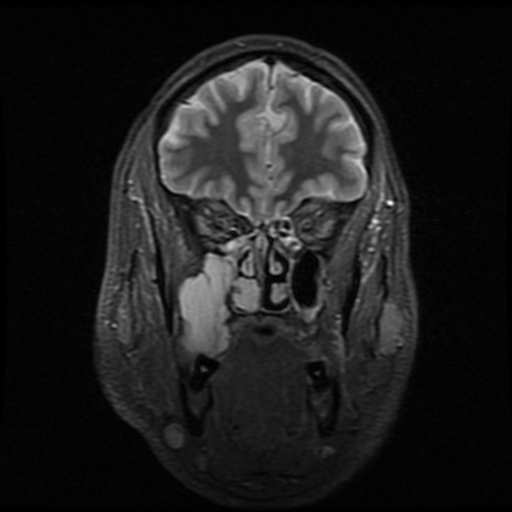 Odontogenic myxoma | Image | Radiopaedia.org