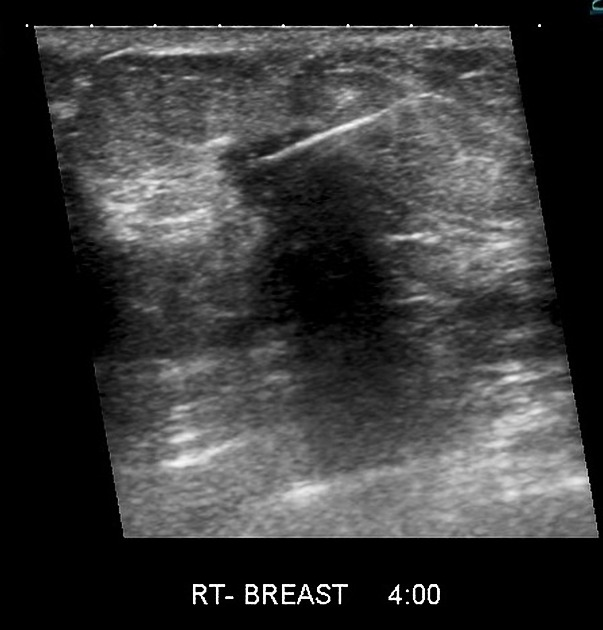 Breast Biopsy Austin TX  Ultrasound Guided Biopsy