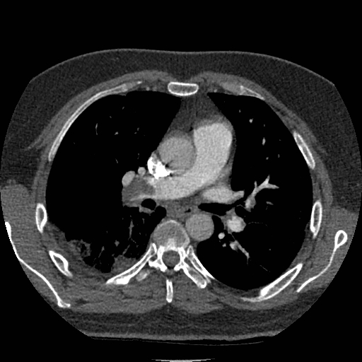 Pulmonary embolism with lung infarcts | Image | Radiopaedia.org