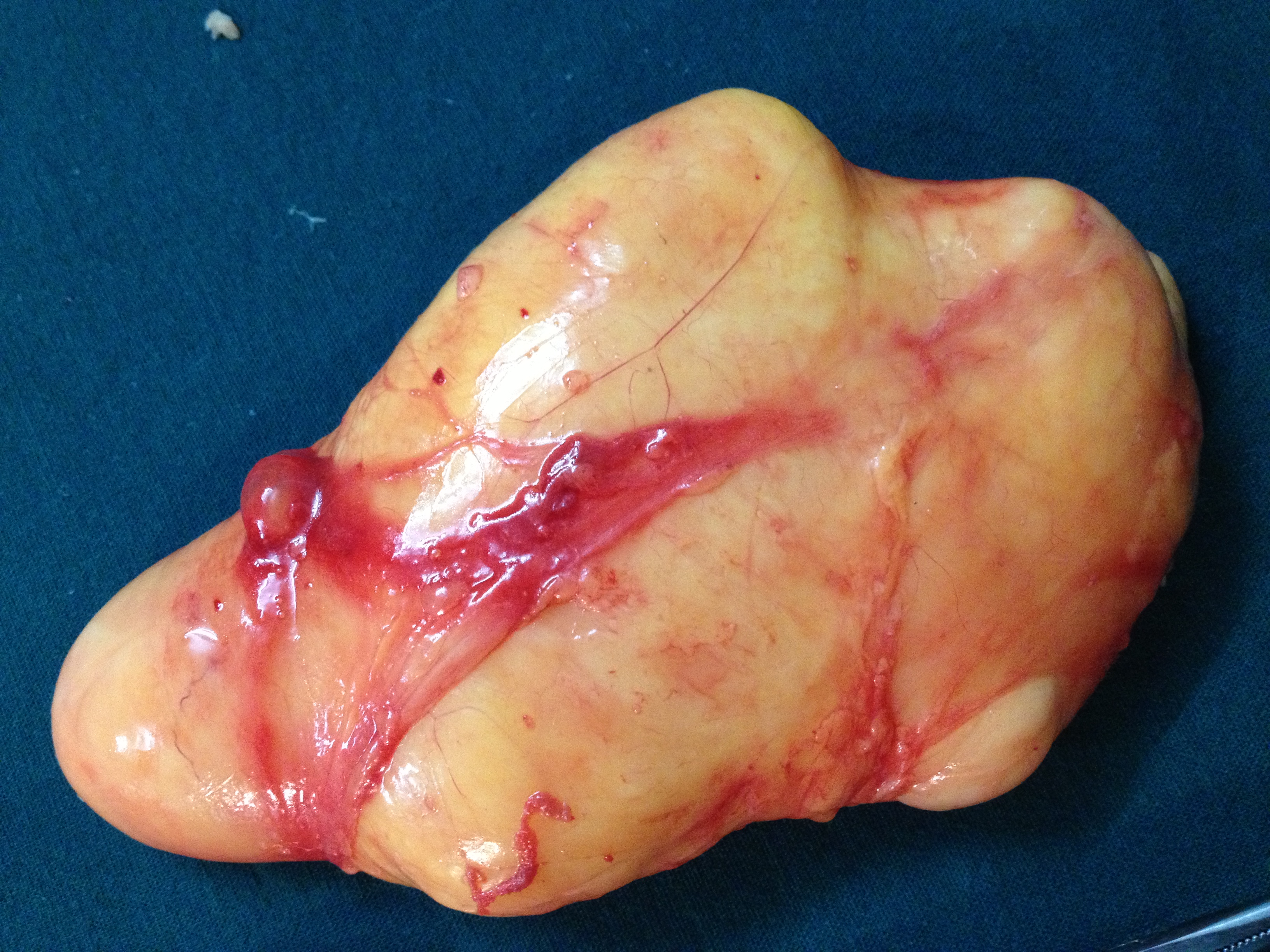 Lipoma - arm | Image | Radiopaedia.org