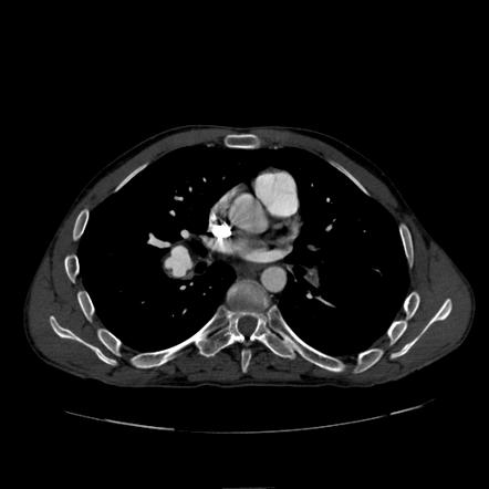 Celiac Artery Vasculitis Radiology